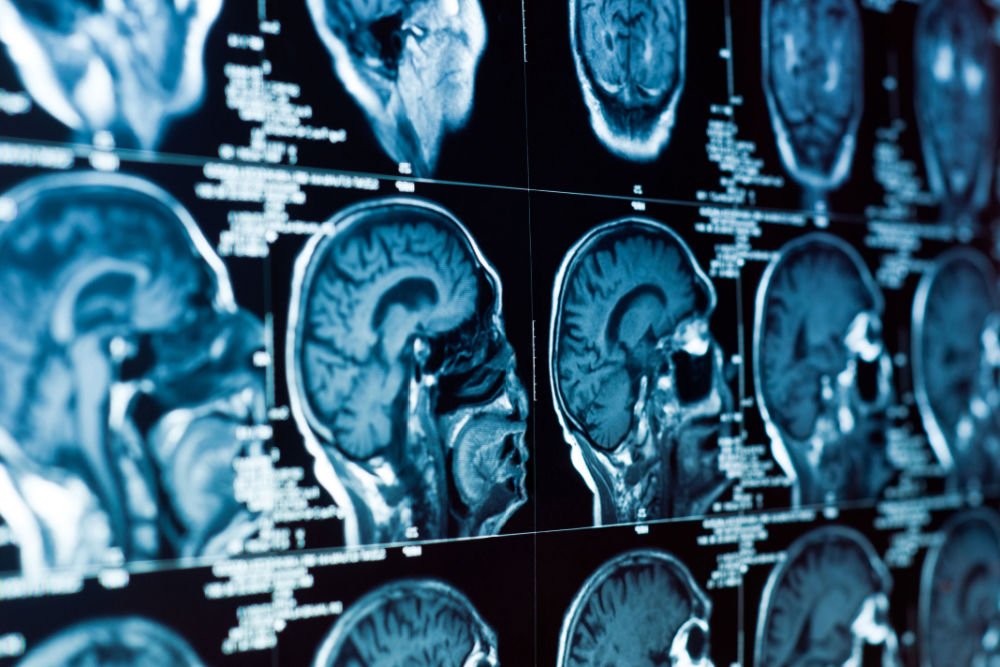 What We Learned From a Deep Dive into Neuroscience Research Giving