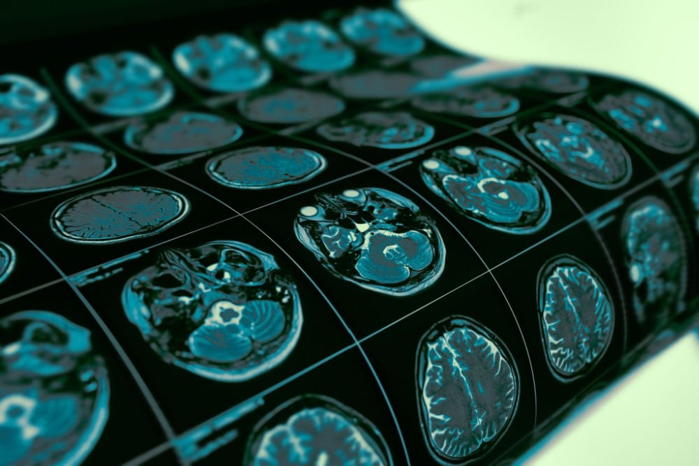 This Research Funder Is on a Mission to Cure — and Destigmatize — Epilepsy