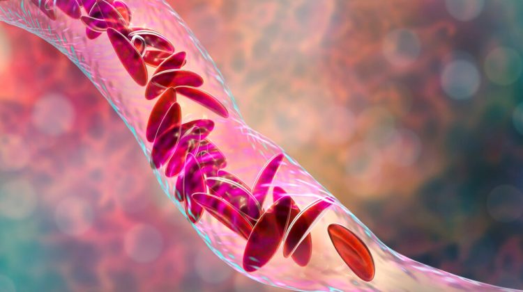 Banner for article Almost No Foundations Are Backing Work on Sickle Cell Disease. It's Time for That to Change