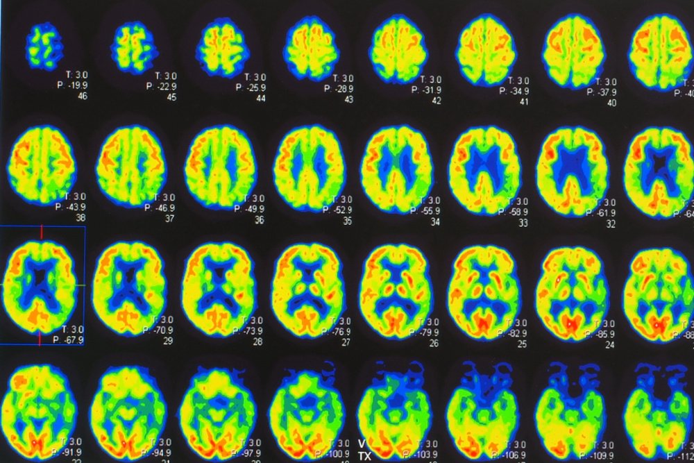 A Big Gift to UC San Diego is the Latest Philanthropic Push to Better Understand Psychedelics