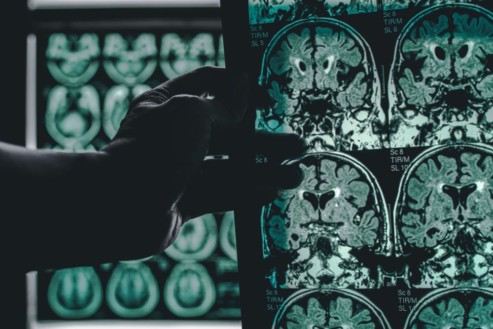 A Major Gift for Alzheimer’s at a Pivotal Time for the Development of Treatments